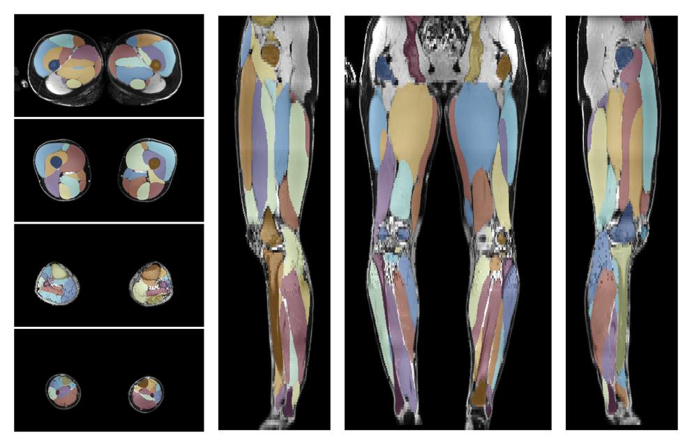 Overlay of automated muscle segmentation labels on dixon water image.